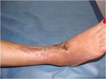 Lower leg ulcers - after SKT reconstruction by Thiersch